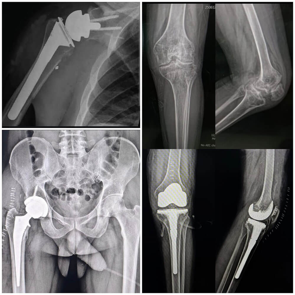 Joint Replacement Surgery