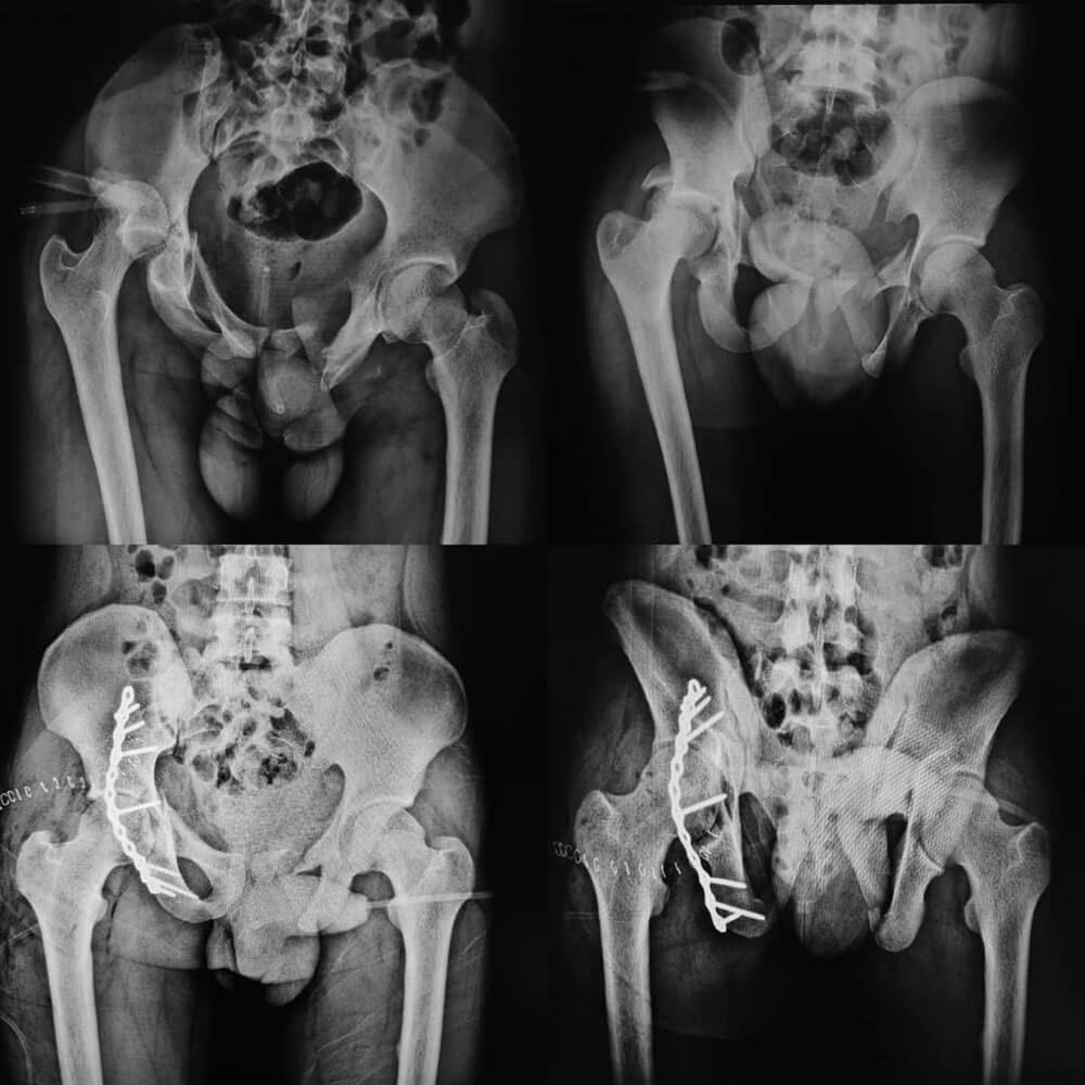 Pelvi-acetabular Trauma Surgery