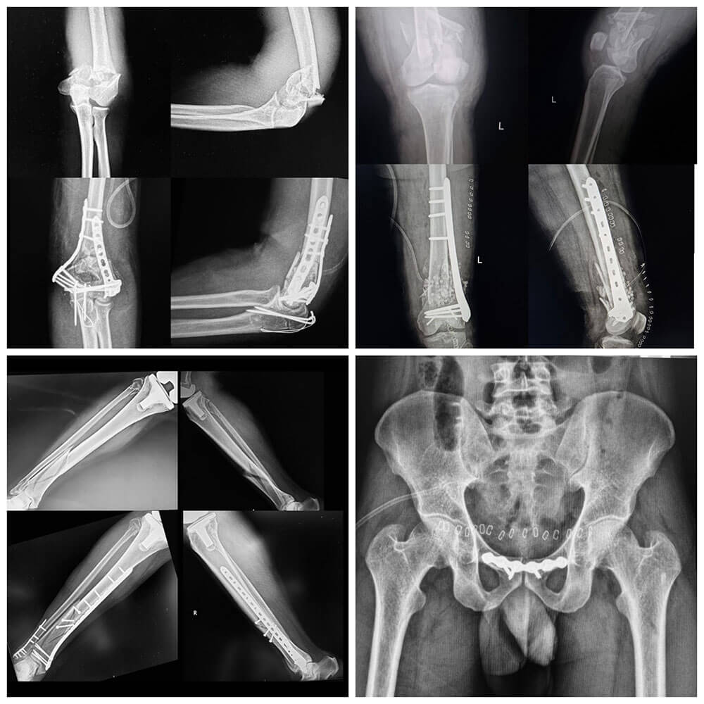 Complex Trauma and Fracture Fixation