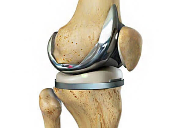 Total Knee Replacement