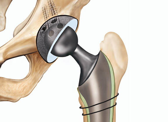 Total Hip Replacement
