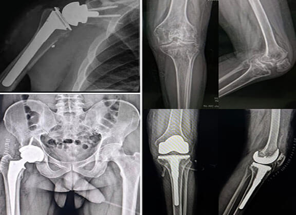 Joint Replacement Surgery