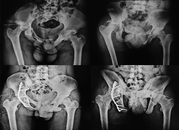 Pelvi-acetabular Trauma Surgery