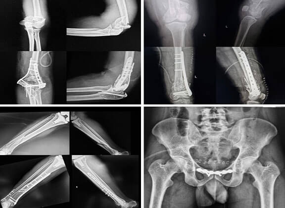 Complex Trauma and Fracture Fixation