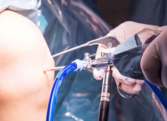 Arthroscopy