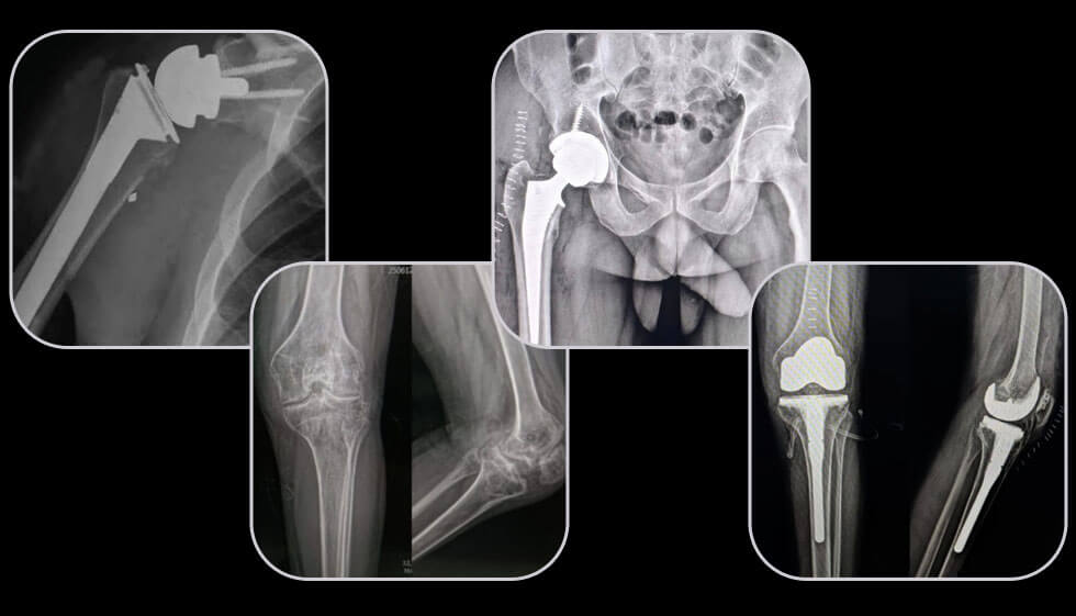 Joint Replacement Surgery by Dr. Sandeep Gavhale