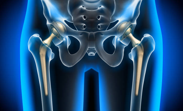 Hip Replacement Surgeon