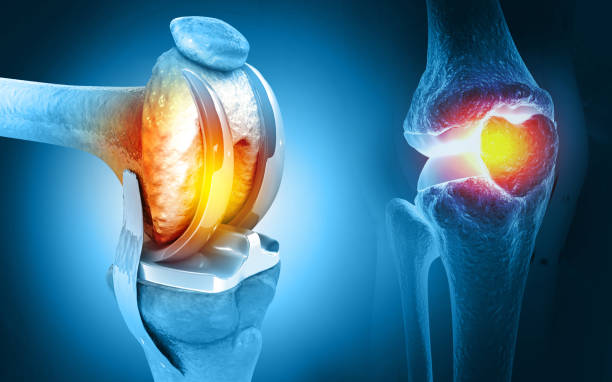 Knee Replacement Specialist