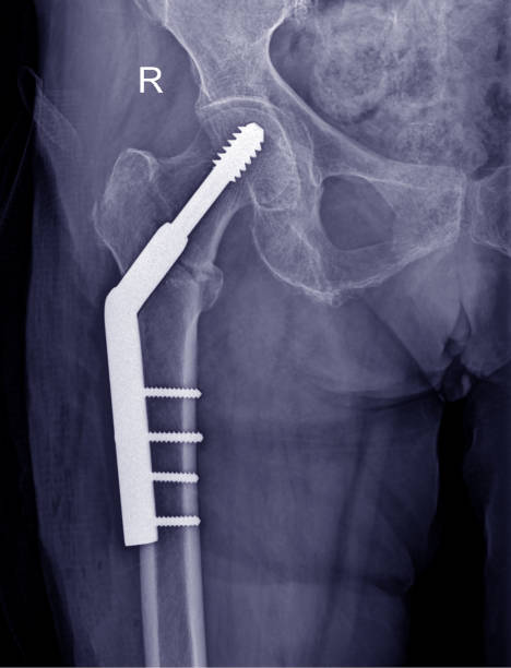 Complex Fracture Fixation 
