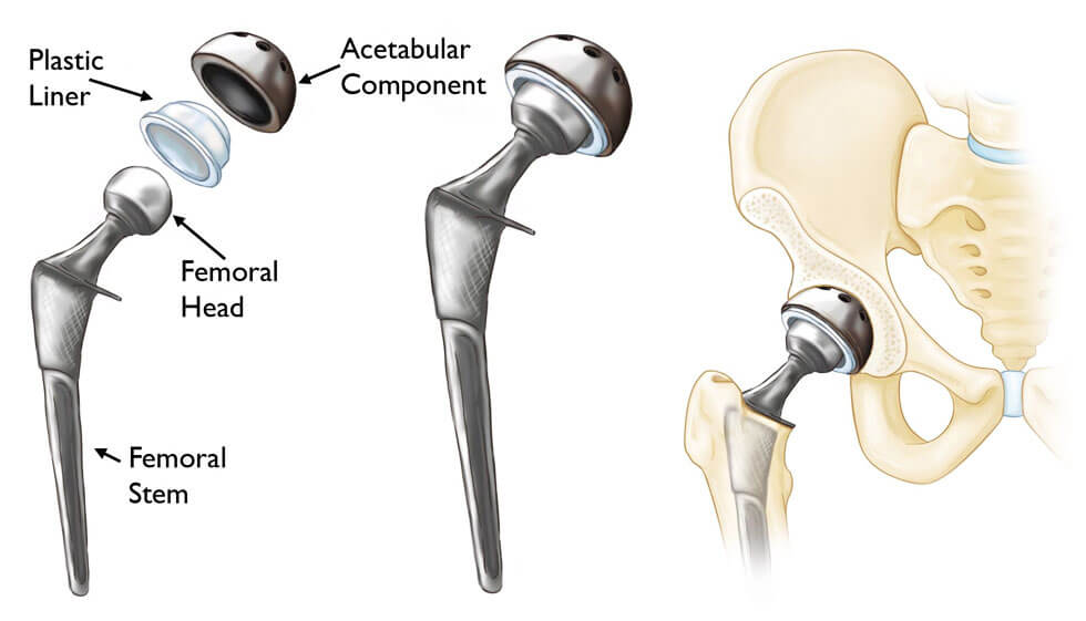 Total Hip Replacement (THR) - hip arthroplasty