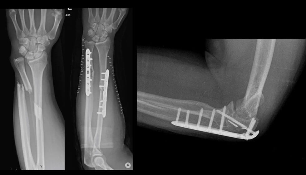 Complex Trauma and Fracture Fixation Surgery